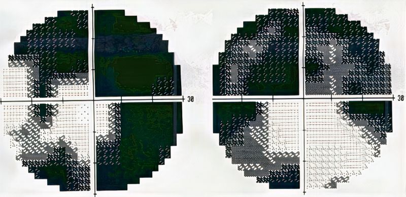 File:Bilateral HVF EBS .jpg