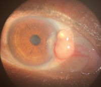 A case of inflamed nasal pterygium with cystic degeneration. ccentuates tear film abnormality causing adjacent Dellen or excavation of cornea.