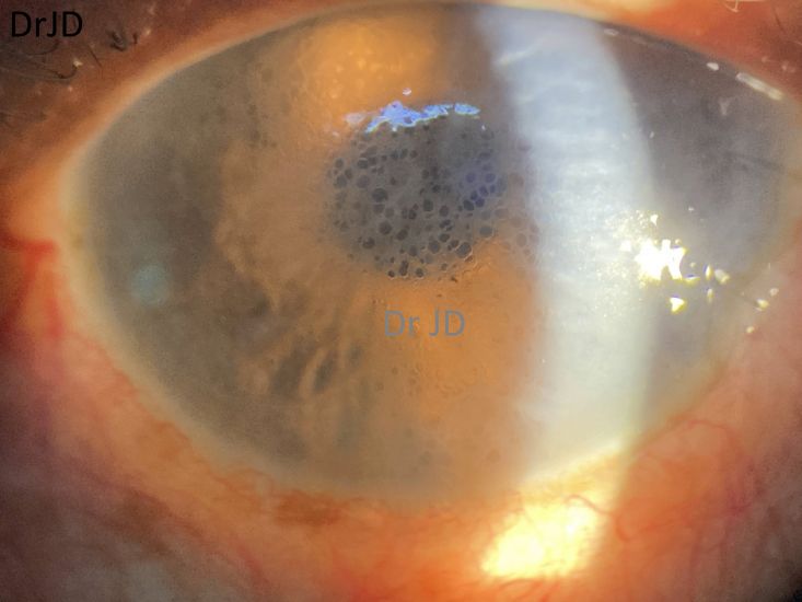 Honeycomb corneal edema on Netarsudil use