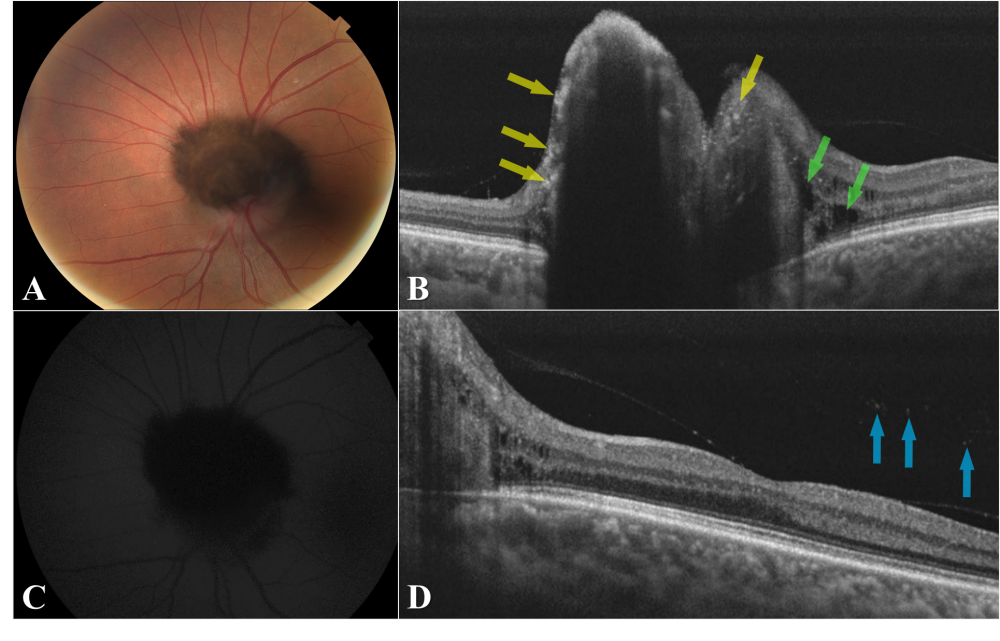 Optic Disk Melanocytoma and Optical Coherence Tomography Angiography ...
