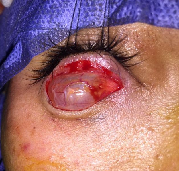 File:Lower lid WGDC infraciliary.JPG