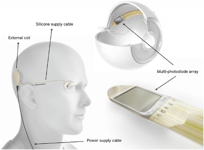 File:Retina Implant Alpha AMS System.jpeg