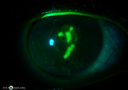 Herpes Simplex Epithelial Keratitis - EyeWiki