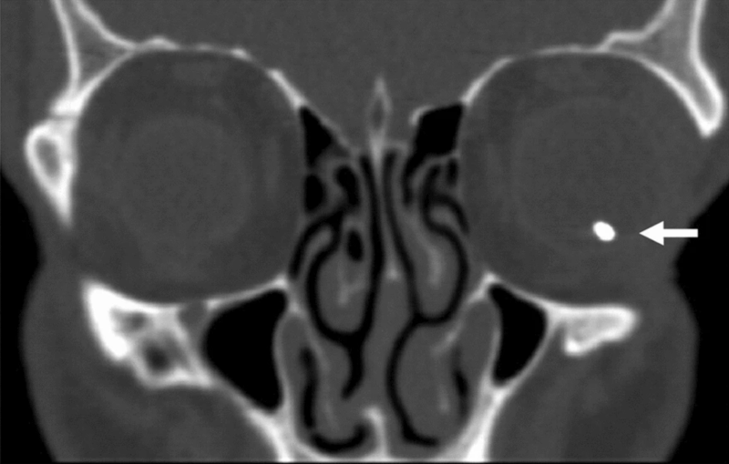 File:CT Metallic IOFB.PNG