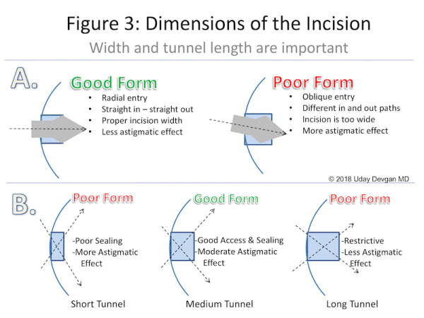 Posterior Capsular Rent - EyeWiki