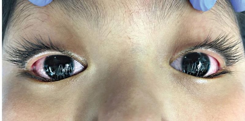 File:Eyelid epiblepharon.jpg