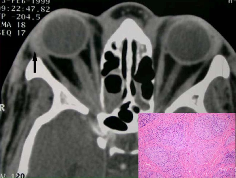 File:Sarcoidosis-02.jpg