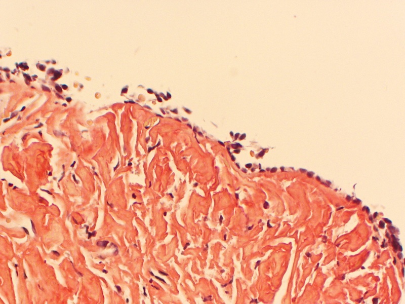 File:Conjunctival Amyloidosis Congo Red.jpg