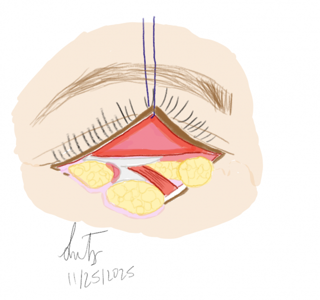 File:Lower Blepharoplasty.png
