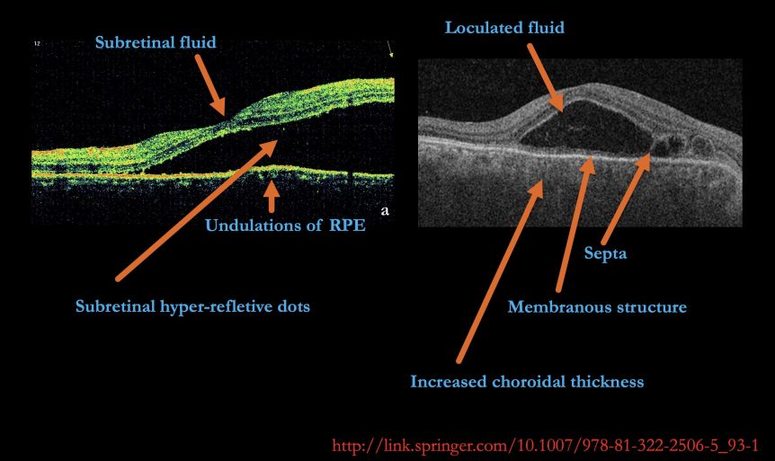 Optical Coherence Tomography - EyeWiki