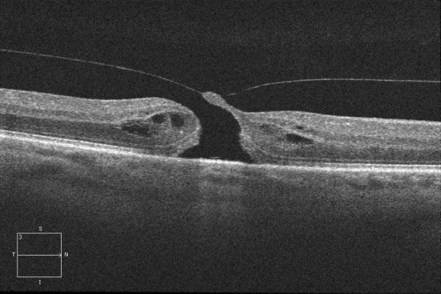 Optical Coherence Tomography - EyeWiki