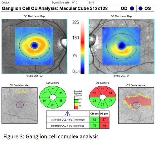 Spectral Domain Optical Coherence Tomography in Glaucoma - EyeWiki