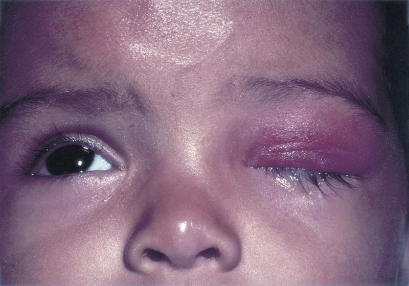 File:Ophthalmia neonatorum.jpg