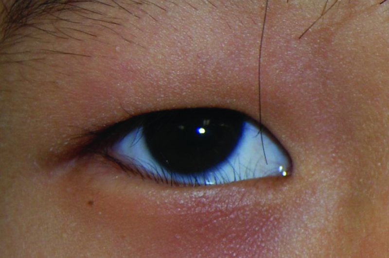 File:Asian patient with epiblepharon.png