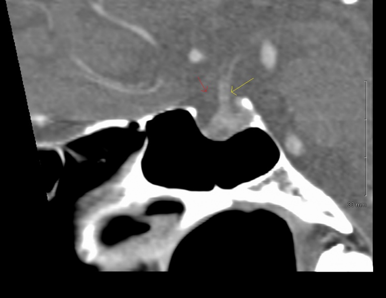 File:Sagittal CT sella.jpg