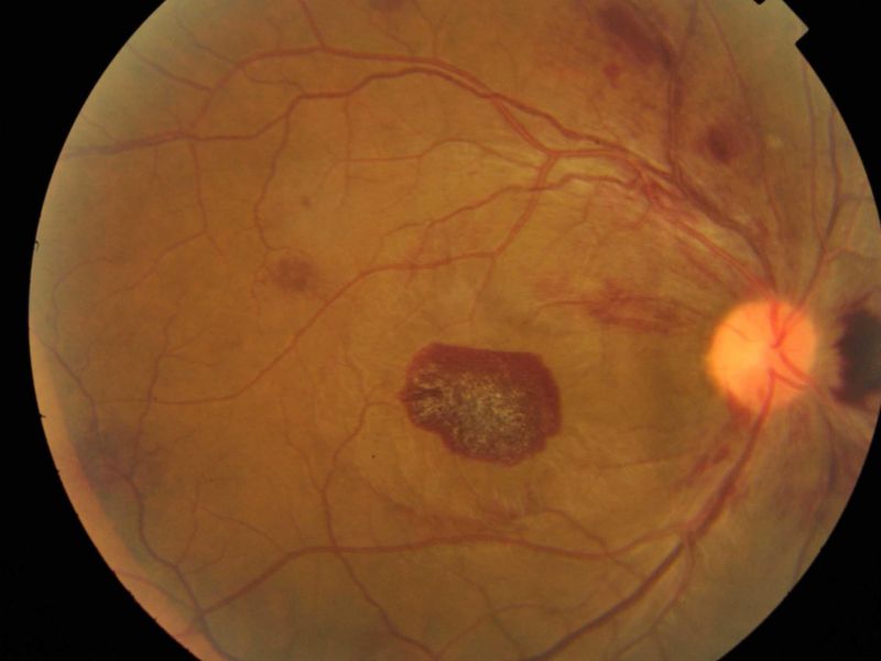 File:Leukemia.jpg
