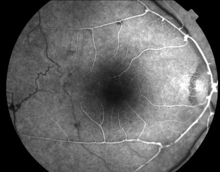 Idiopathic Retinitis, Vasculitis, Aneurysms, and Neuroretinitis (IRVAN ...