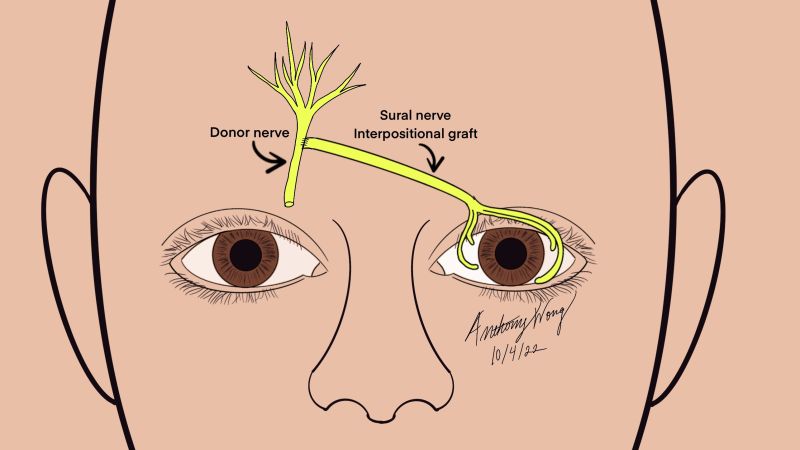 File:Sural nerve contralatralateral.jpg