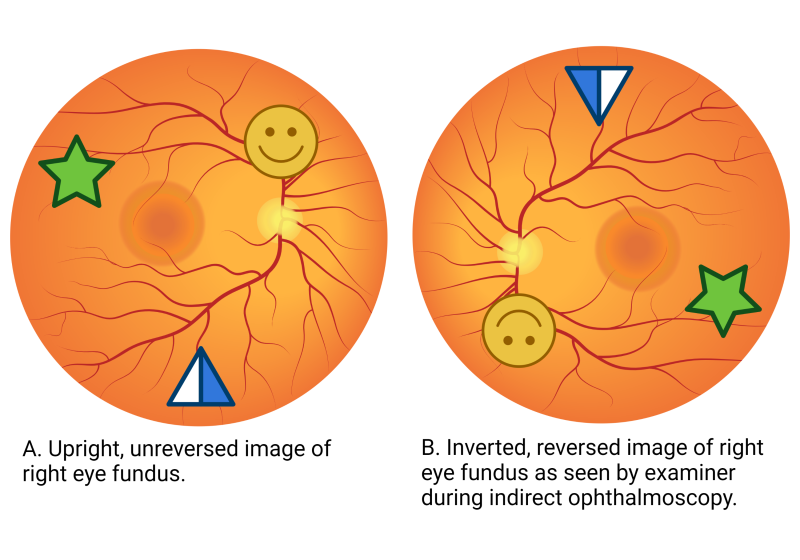 File:Direct vs. Indirect Ophthalmoscope View.png