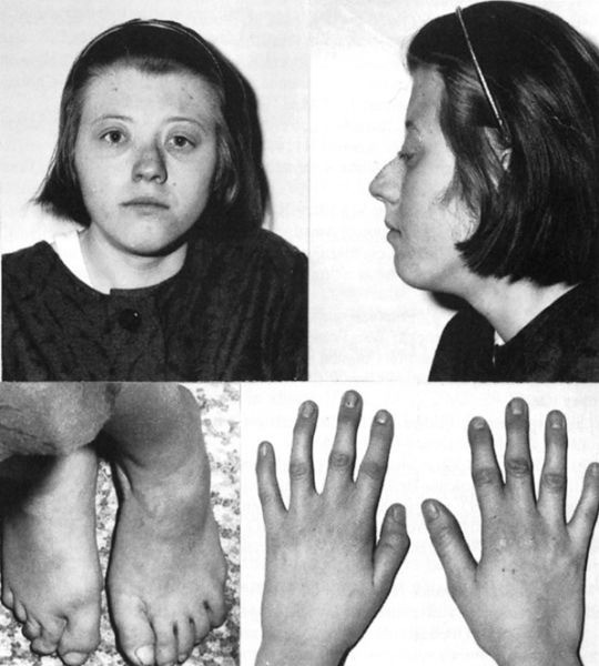File:Saethre Chotzen Syndrome from BCSC.jpg