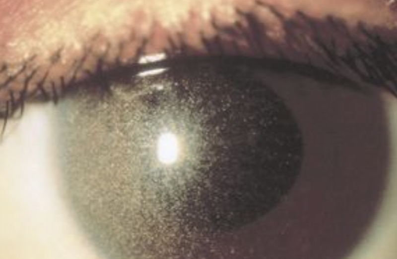 File:Cystinosis AAO.png