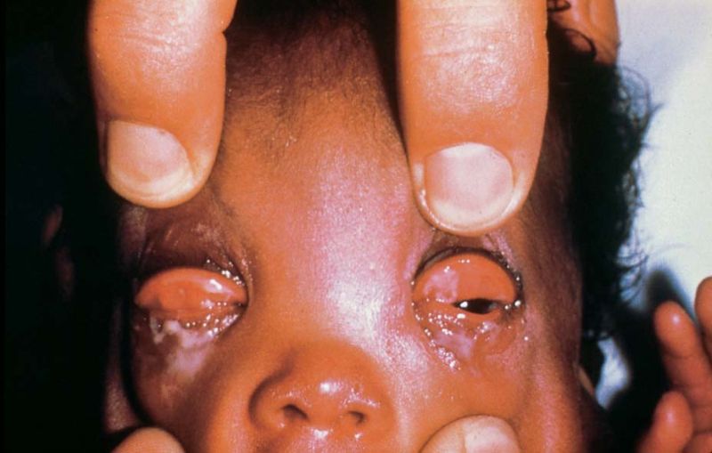 File:Gonococcal conjunctivitis.jpg