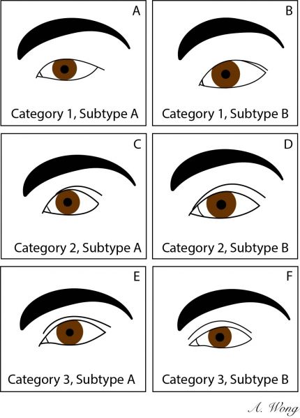 File:Asian Eyelids.jpg
