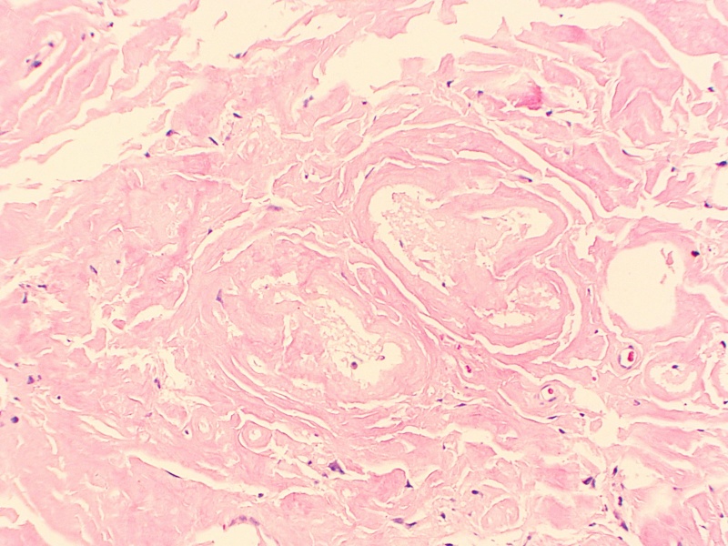 File:Conjunctival Amyloidosis H&E.JPG
