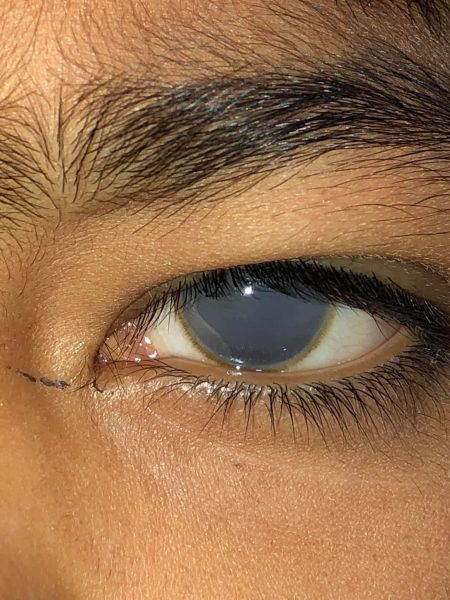 File:Mucopolysaccharoidosis.JPG