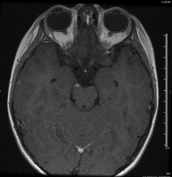 File:Ophthalmic Migraine MRI.jpg