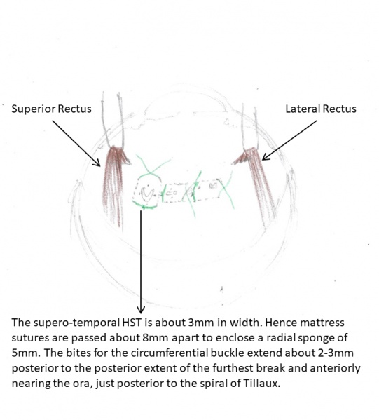 File:Orientation of Buckling 4.jpg