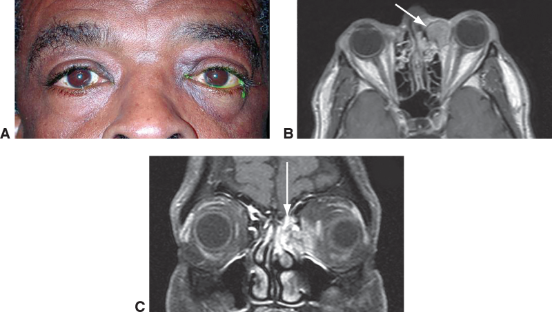 File:Squamous cell carcinoma.png