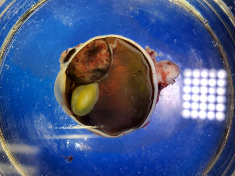 File:Ciliarybodymelanoma.jpeg