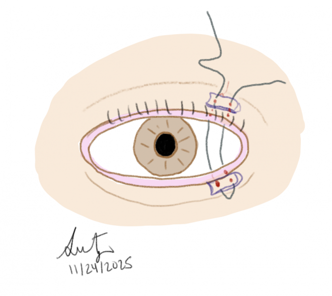 File:Temporary Tarsorrhaphy Image.png