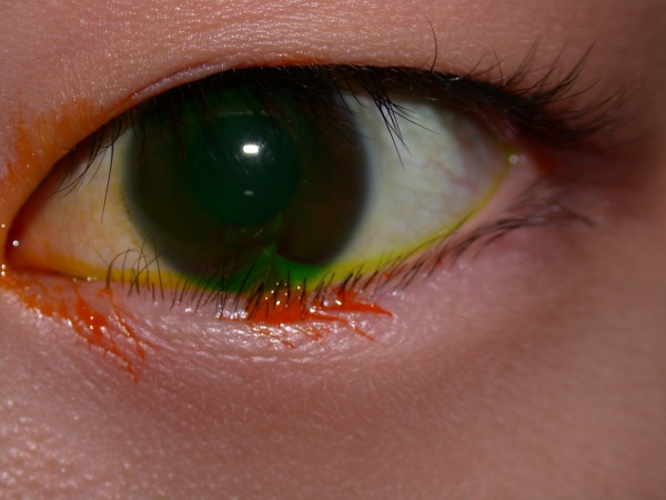 Congenital and Acquired Epiblepharon - EyeWiki
