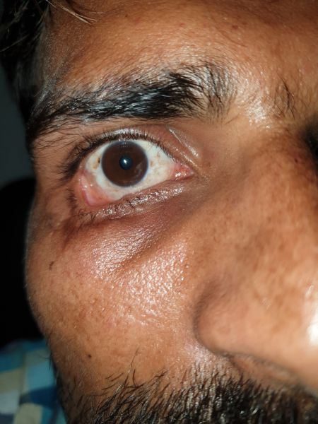 File:Cicatrical ectropian pre-op.jpg.jpg