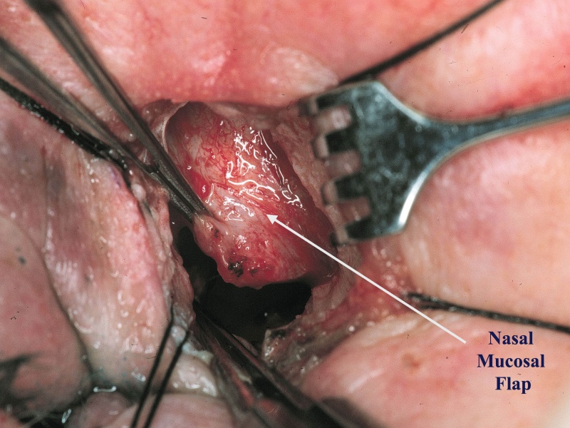 File:Nasal flap.jpg