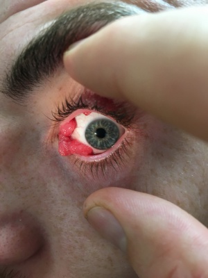 Conjunctival Papilloma.jpeg