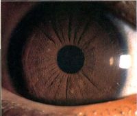 Slit· lamp photograph of a 9-year-old boy with neurofibromatosis type I shows multiple, scattered, yellow Lisch nodules as well as more numerous brown iris nodules uniform in size and distribution.