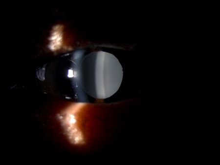 Intraocular Lens Opacification - EyeWiki