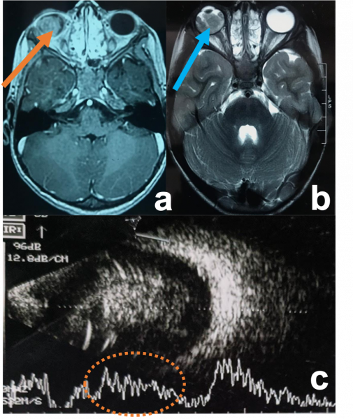 File:Retinoblastoma.png