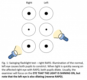 Reverse Relative Afferent Pupillary Defect RAPD EyeWiki