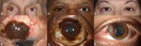 Photographs showing conjunctival melanoma in patients with different skin tones. A, White man with (B) conjunctival melanoma resulting from nevus. C, African American woman with (D) conjunctival melanoma from primary acquired melanosis. E, Hispanic woman with (F) conjunctival melanoma de novo.