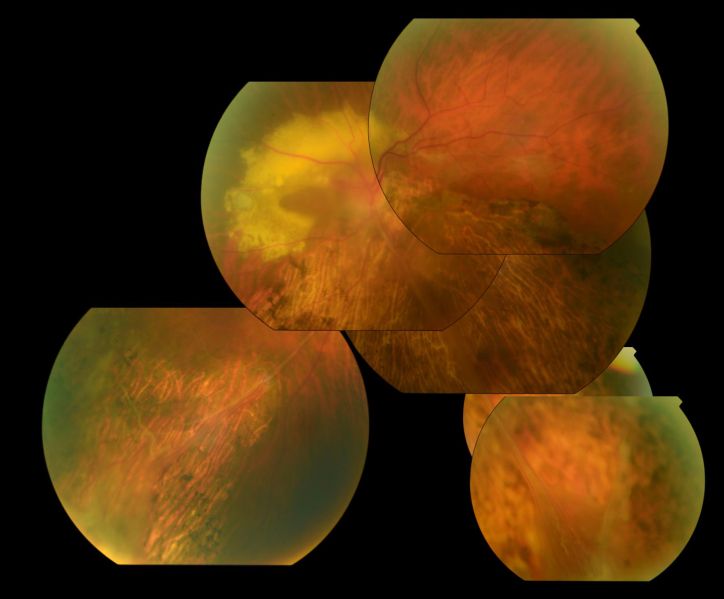 File:Wagner syndrome retina.jpg