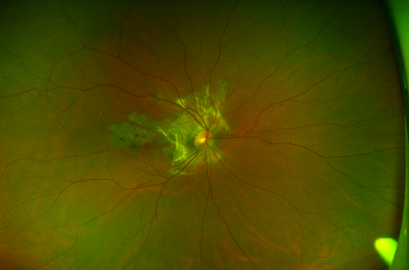 File:Serpiginous optos.png