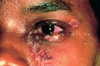 Skin vesicles of herpes simplex virus (HSV) dermatoblepharitis.