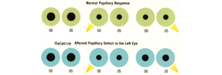 Neuro-ophthalmic Findings in Coma - EyeWiki