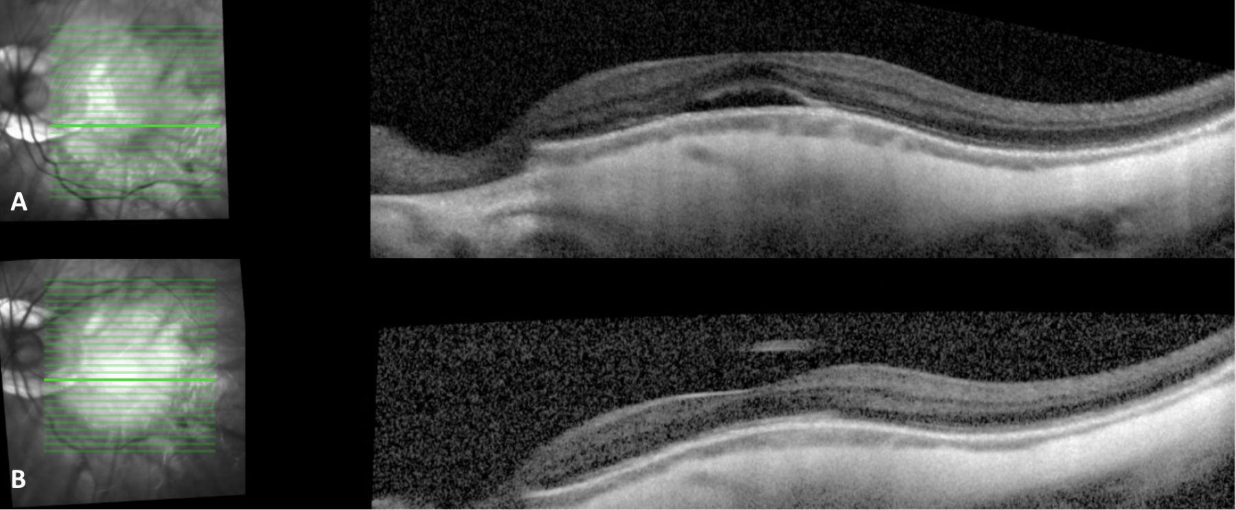 Dome Shaped Macula Eyewiki