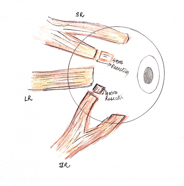 File:Modified Hummelschein.jpg
