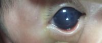 Newborn with congenital glaucoma (right eye), buphthalmos.